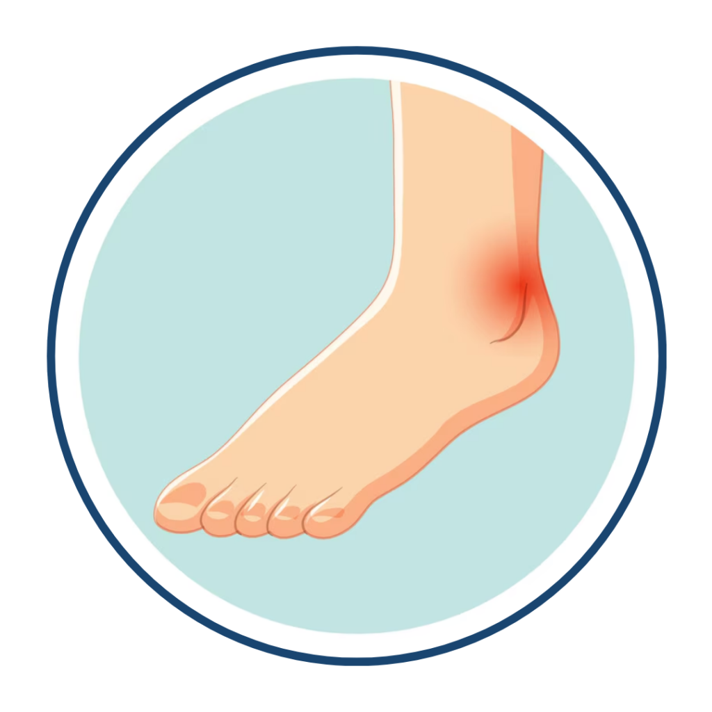 Tarsal Tunnel Syndrome